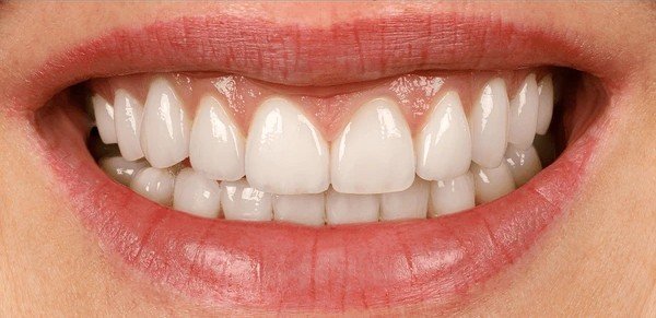 after dental veneers transformation