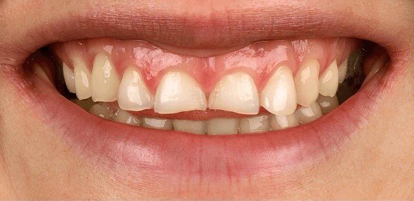 before dental veneers transformation